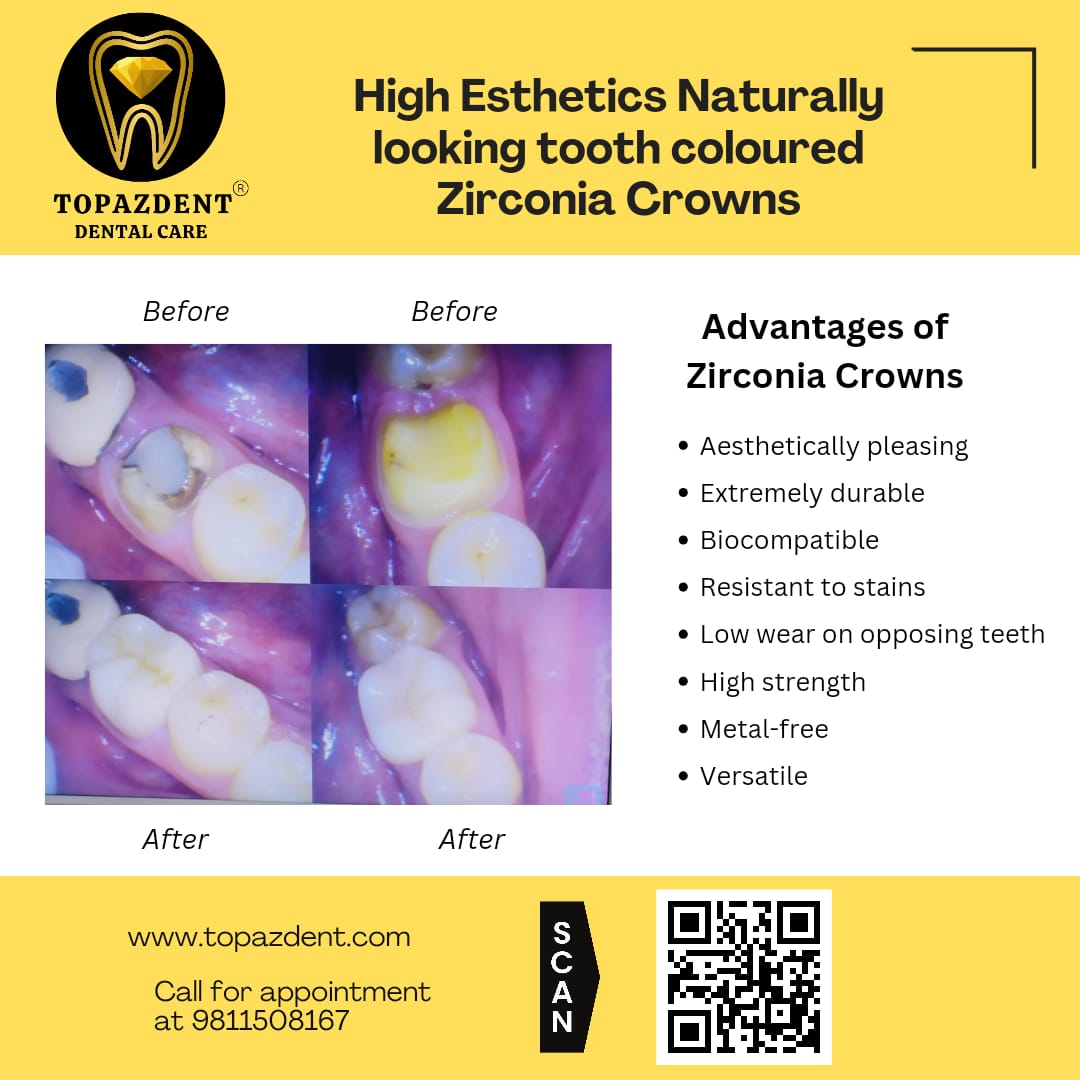 Achieve a Natural Smile with High-Esthetic, Tooth-Colored Zirconia Crowns: The Ultimate Solution for Dental Restorations 